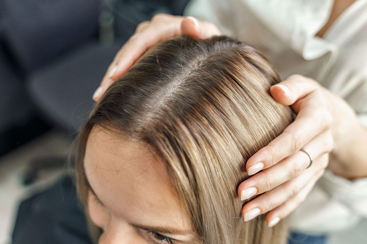 Tóc mỏng thưa ở đường ngôi