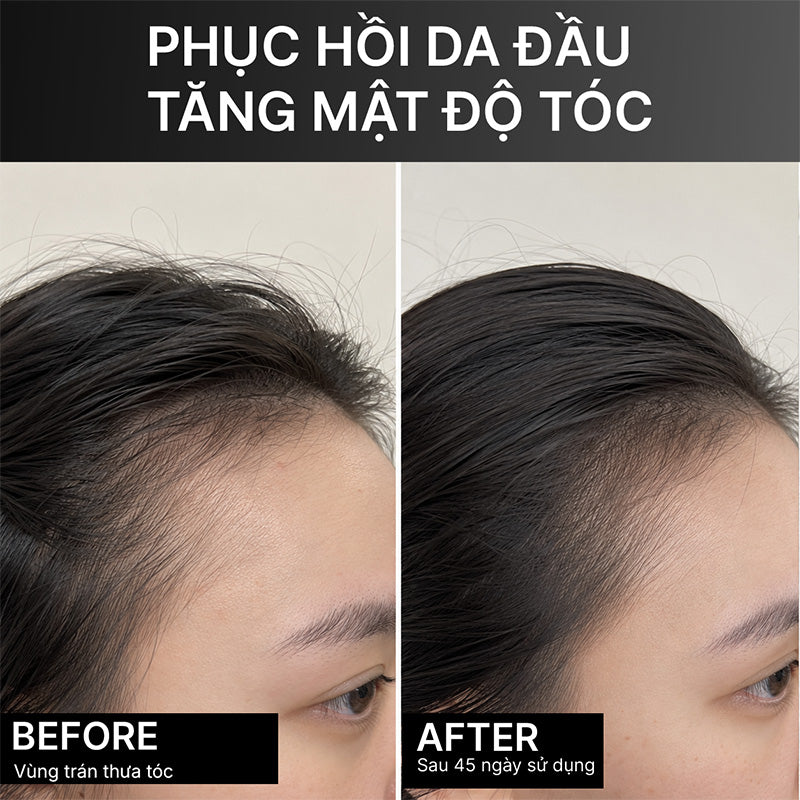 Kết quả trước và sau khi dùng serum dưỡng nang tóc Divaren