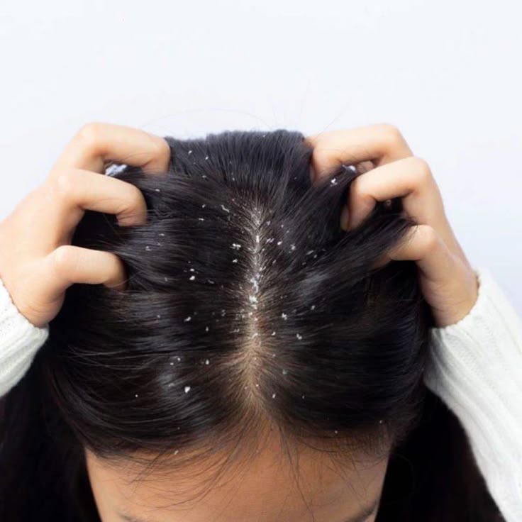 Da đầu ngứa và có gàu