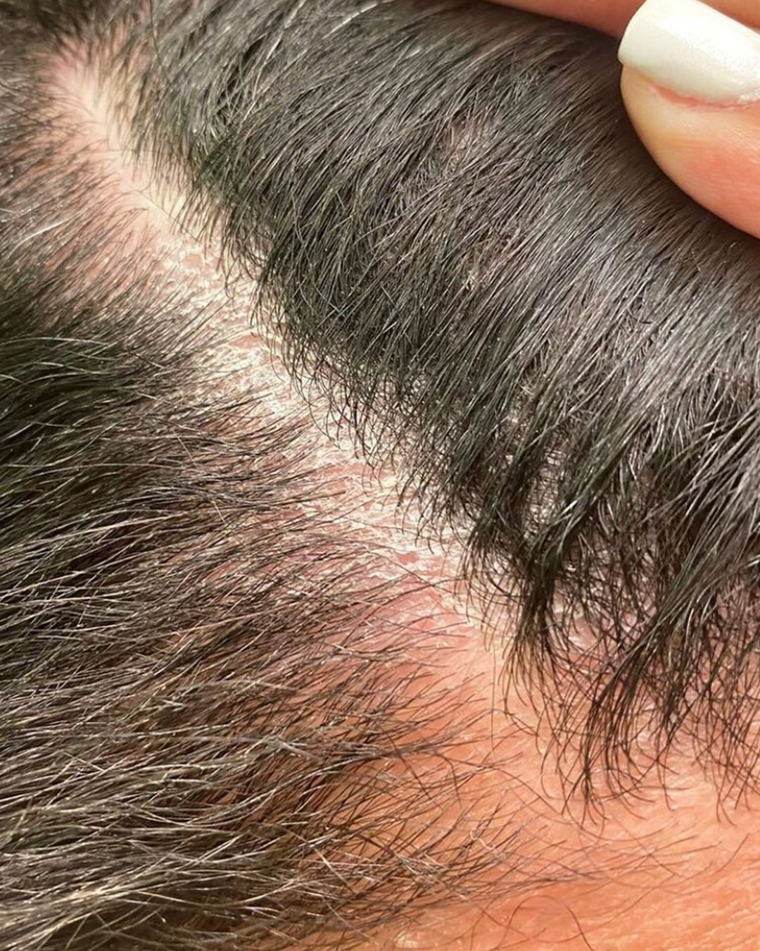 Chăm sóc và làm sạch sâu da đầu
