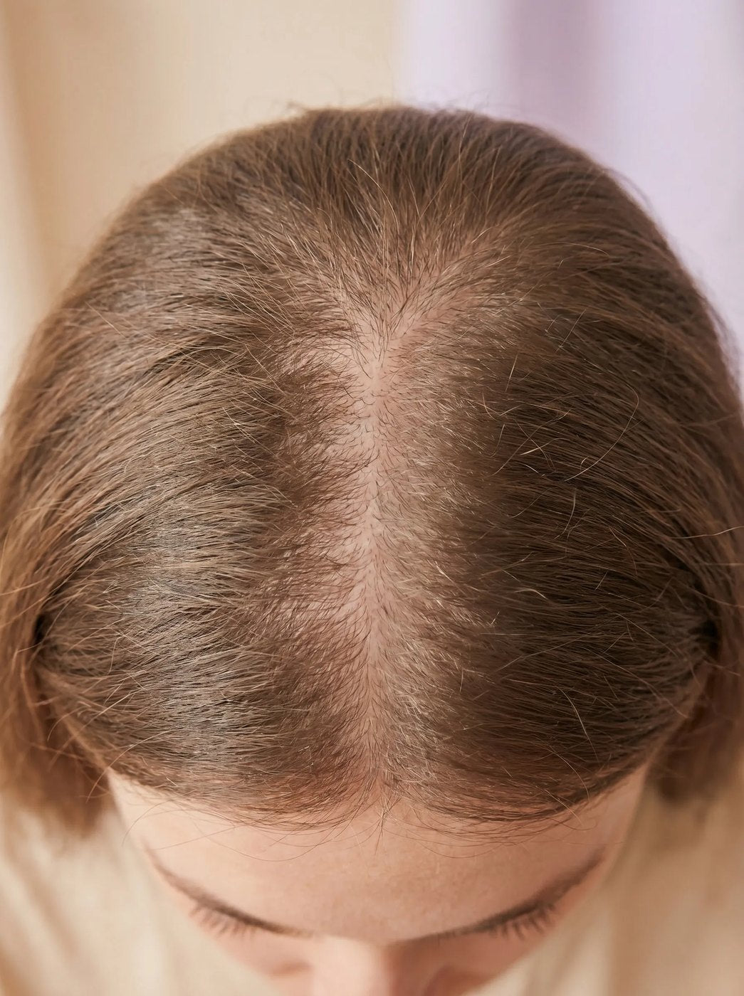 Tóc thưa ở đỉnh đầu lộ da đầu ở nữ