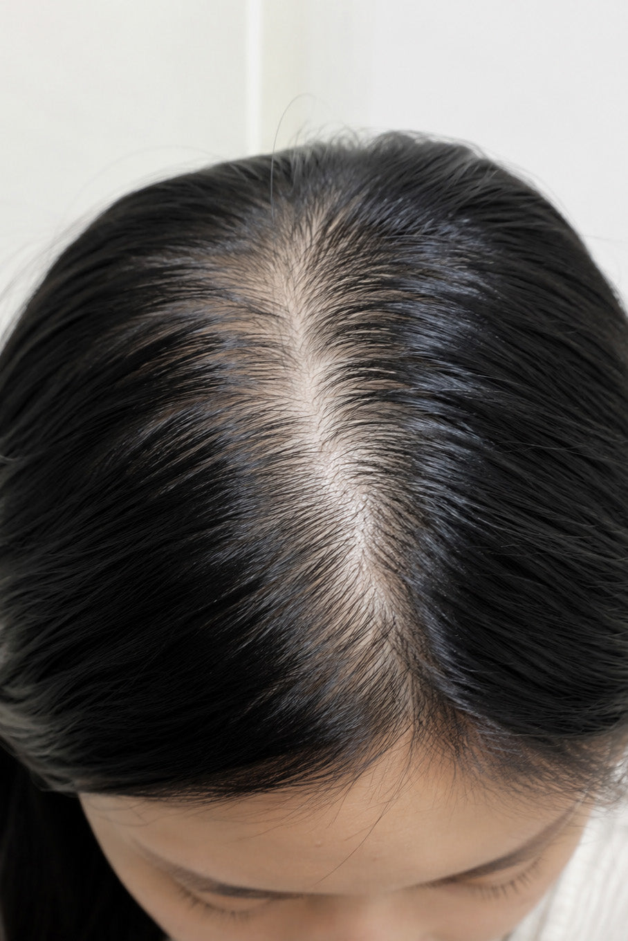Tóc thưa mảnh, lộ da đầu